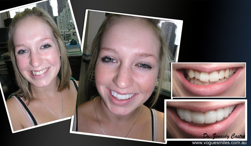 Facetas Odontológicas Removíveis - SmileVeneers