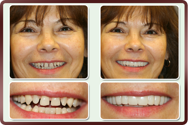 Facetas Odontológicas Removíveis - SmileVeneers