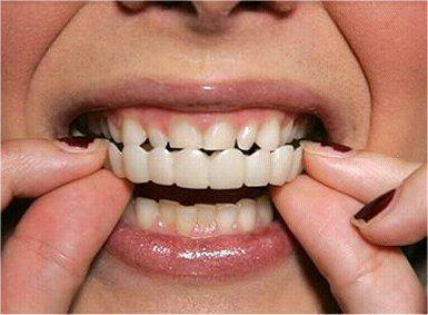 Facetas Odontológicas Removíveis - SmileVeneers