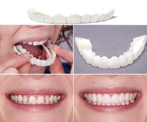 Facetas Odontológicas Removíveis - SmileVeneers