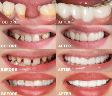 Facetas Odontológicas Removíveis - SmileVeneers